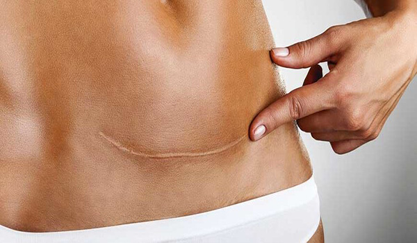 fraksiyonel lazer iz tedavisi